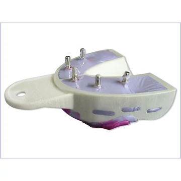 Miratray Implant Lenyomatkanál I1 Alsó Hager (6db)